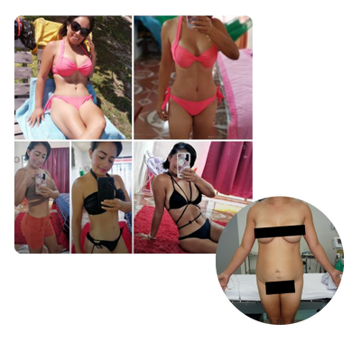 M. J. L. testimonio abdominoplastia