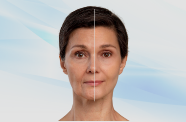 Rejuvenecimiento Facial
