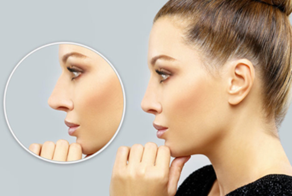 Rinoplastia: beneficios que transforman salud y confianza