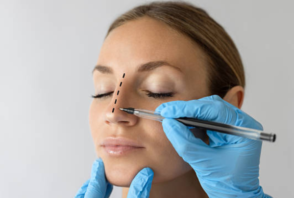 Rinoplastia cambia rostro al mejorar armonía facial