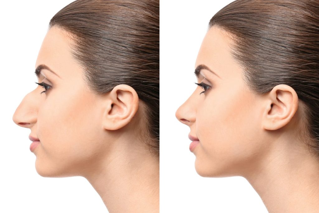 Cirujanos explican cómo la rinoplastia reduce la giba dorsal nasal