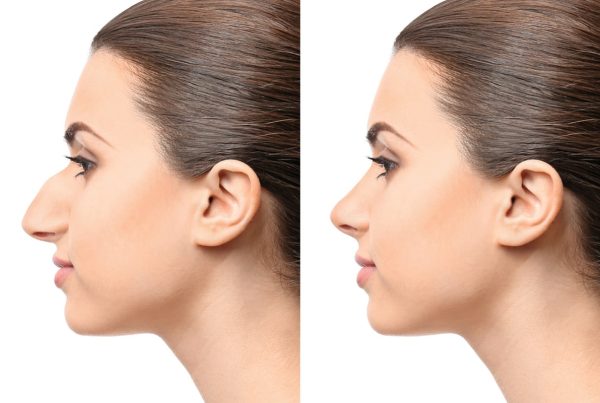 Cirujanos explican cómo la rinoplastia reduce la giba dorsal nasal