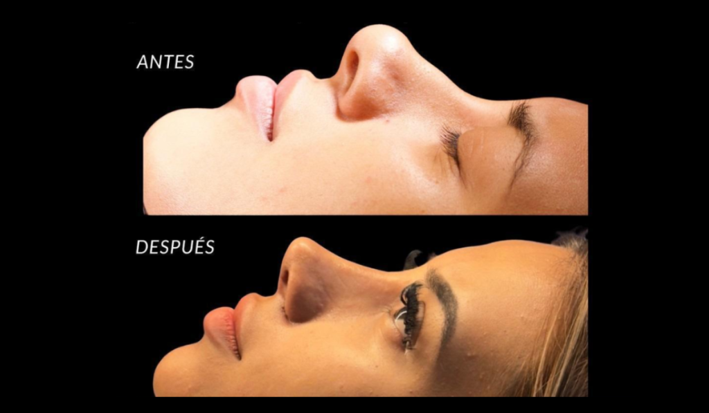 procedimiento de la rinoplastia