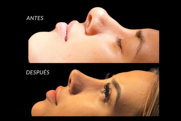 procedimiento de la rinoplastia