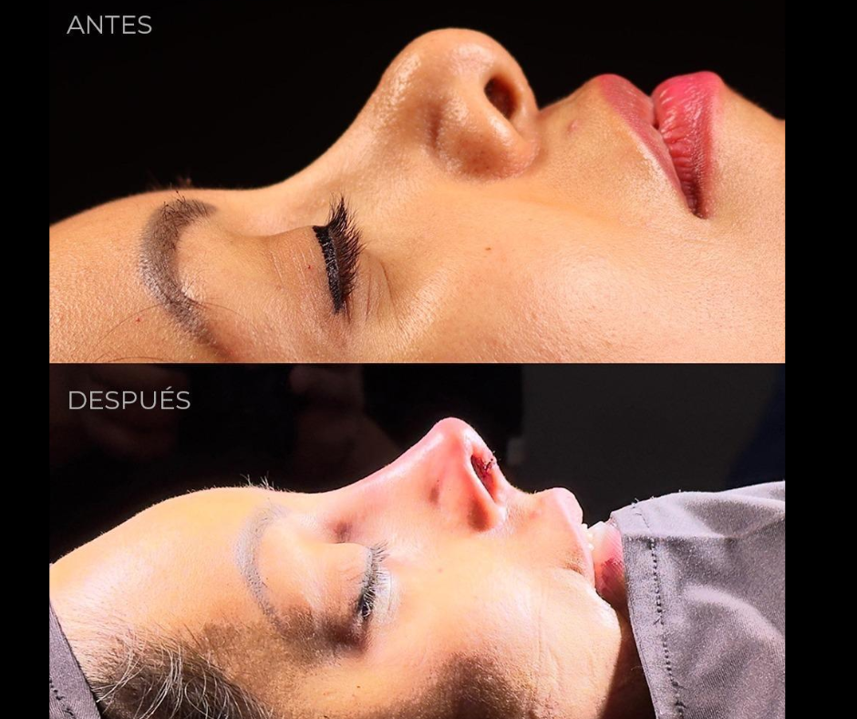 proceso de la rinoplastia