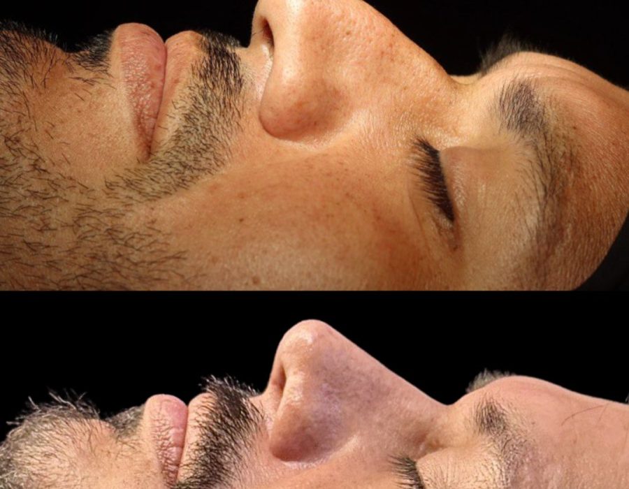 Antes y después de una rinoplastia con recuperación favorable.