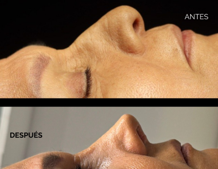 Antes y después de una rinoplastia primaria personalizada.