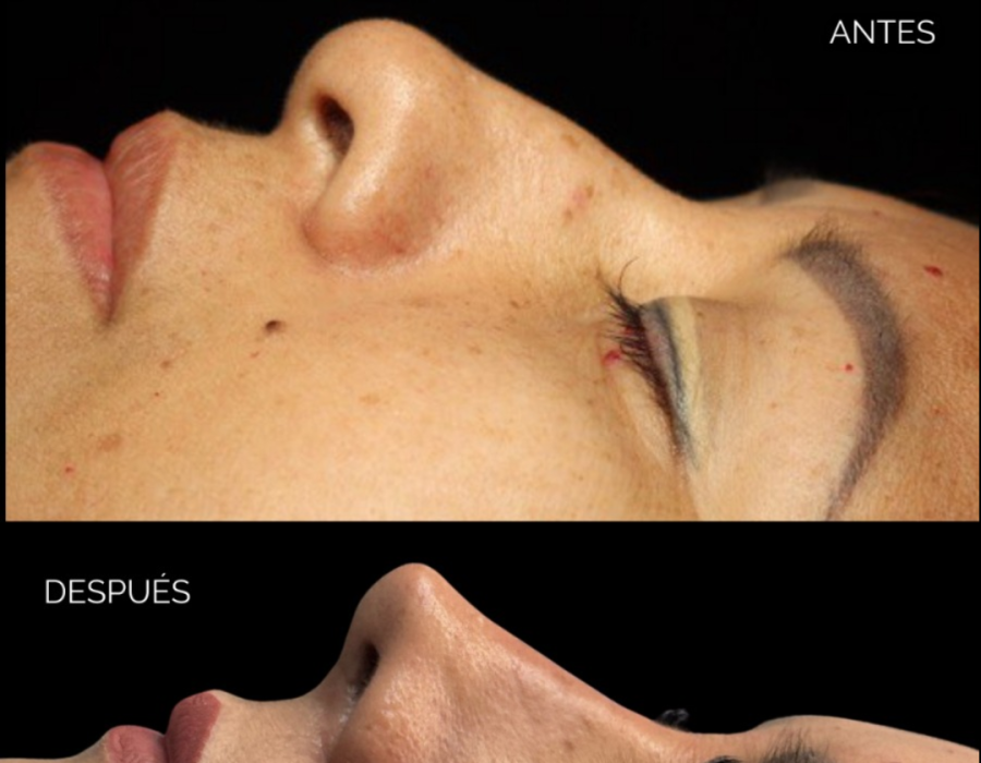 Cambio estético de nariz mediante rinoplastia primaria.