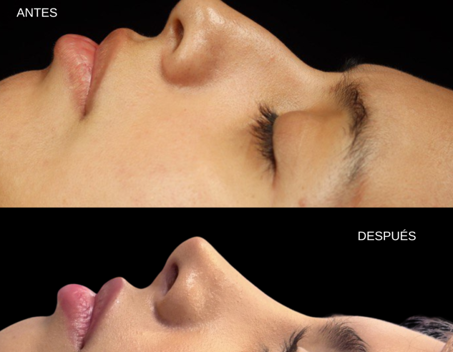 Corrección de dorso nasal mediante rinoplastia primaria.
