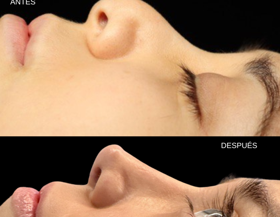 Resultado de cirugía de nariz para mejorar la armonía facial.
