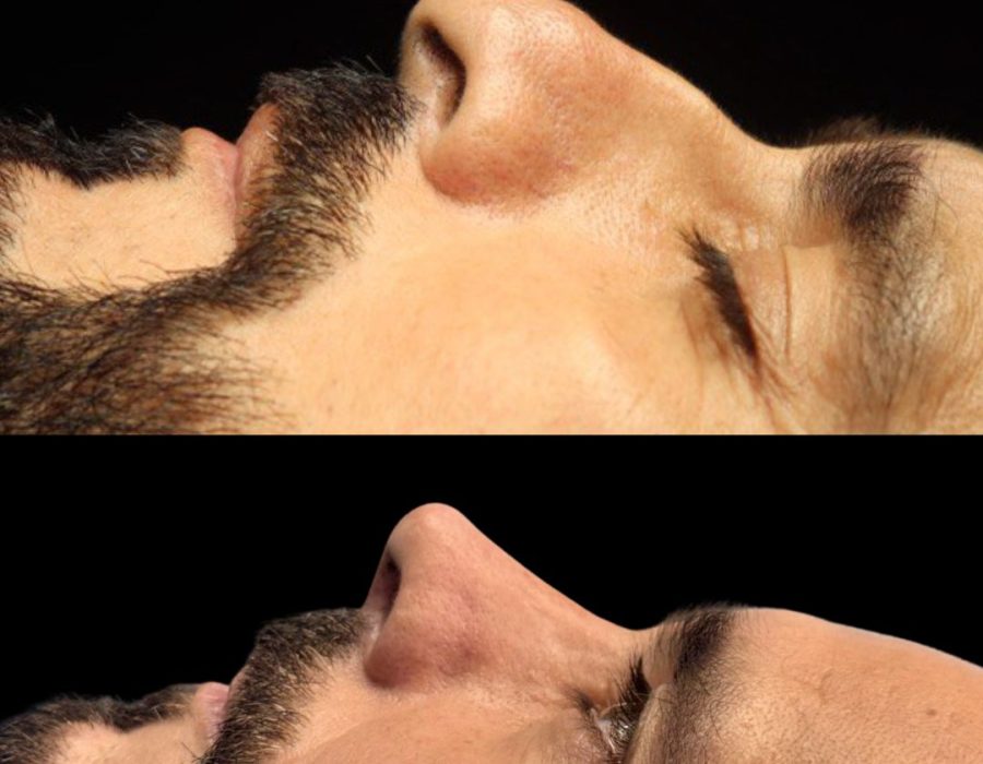 Resultado de rinoplastia para corregir una nariz prominente.