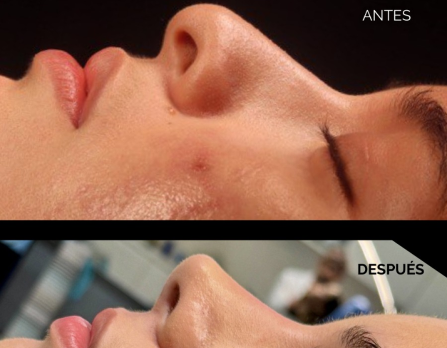 Resultado de rinoplastia primaria realizado en Mérida con un aspecto natural.