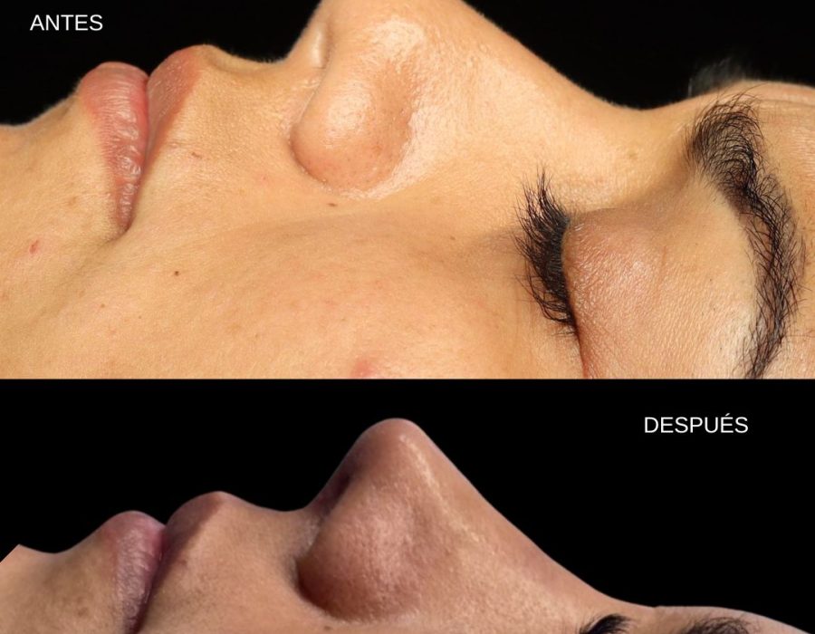 Resultado de rinoplastia secundaria para corregir una cirugía previa.