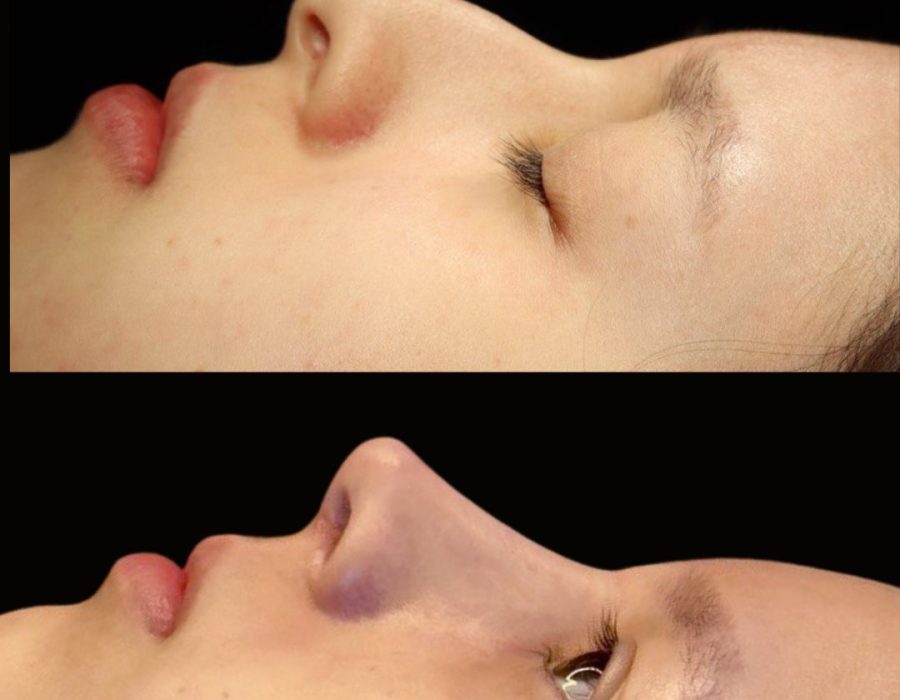 Resultado natural de una rinoplastia estética en paciente femenina.