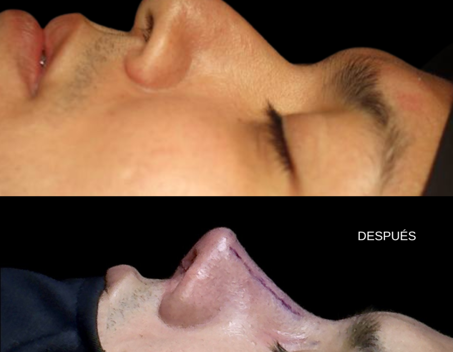 Rinoplastia primaria con definición de punta nasal y perfil.