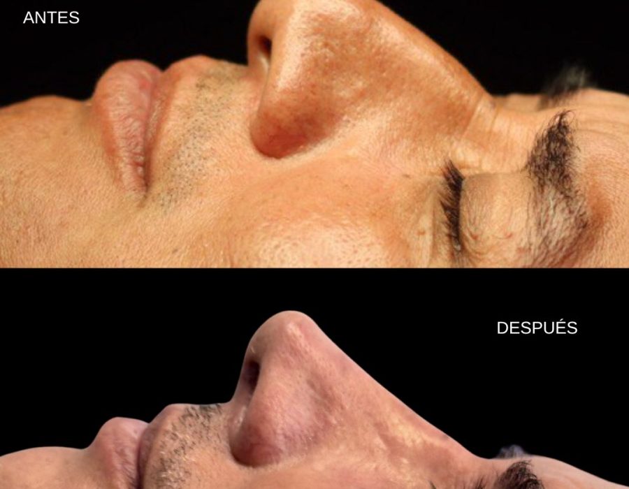Rinoplastia primaria para mejorar el equilibrio del rostro.