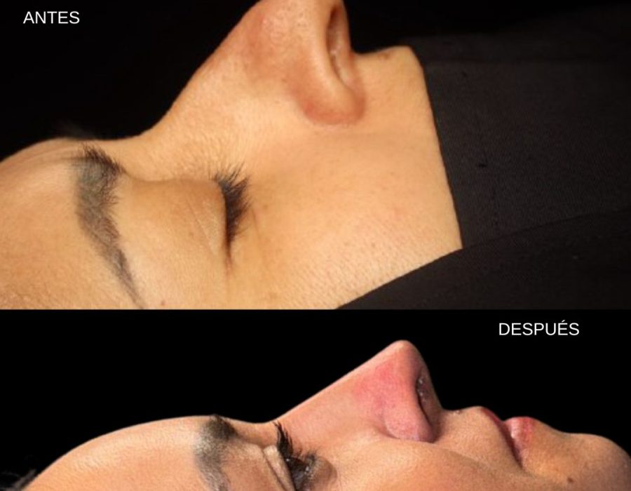 Transformación facial mediante rinoplastia primaria.