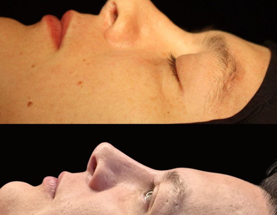 Antes y después de una rinoplastia cuaternaria realizada en Mérida.