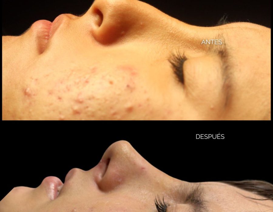 rinoplastia Primaria en nariz con síndrome de binder