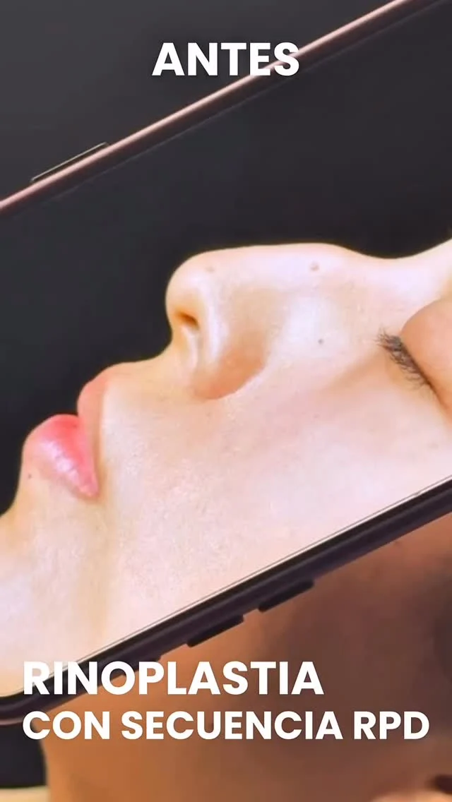 𝗥𝗣𝗗 – 𝗥ENACE TU 𝗣ERFIL 𝗗EFINITIVO 
✨🌷Redescubre tu esencia con una nariz que refleje quién eres.
La rinoplastia ultrasónica con secuencia RPD transforma con precisión y sutileza, devolviéndote confianza desde el primer reflejo.

𝗥𝗶𝗻𝗼𝗽𝗹𝗮𝘀𝘁𝗶𝗮 𝗨𝗹𝘁𝗿𝗮𝘀𝗼́𝗻𝗶𝗰𝗮 𝗰𝗼𝗻 𝘀𝗲𝗰𝘂𝗲𝗻𝗰𝗶𝗮 𝗥𝗣𝗗
✅𝗔𝗴𝗲𝗻𝗱𝗮 𝘁𝘂 𝗰𝗶𝘁𝗮 𝗵𝗼𝘆 𝗺𝗶𝘀𝗺𝗼
Dirígete al siguiente Link 👇🏻
Paso 1._ Realiza la valoración Online.
https://doctorfajardo.com/valoraciones-online/
paso 2._Obtén tu consulta personal gratuita
paso 3._Obtén tu cotización y agenda tu cirugía.
Ubicamos en el Hospital Star Médica 🏥
Consultorio 723 
C. 26 199, Col. Altabrisa, 97130 Mérida, Yuc. 📍
📱 Contáctanos: 9992 45 73 83 Ver menos