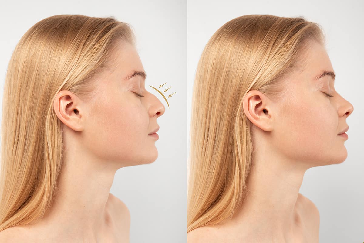 rinoplastia en mérida