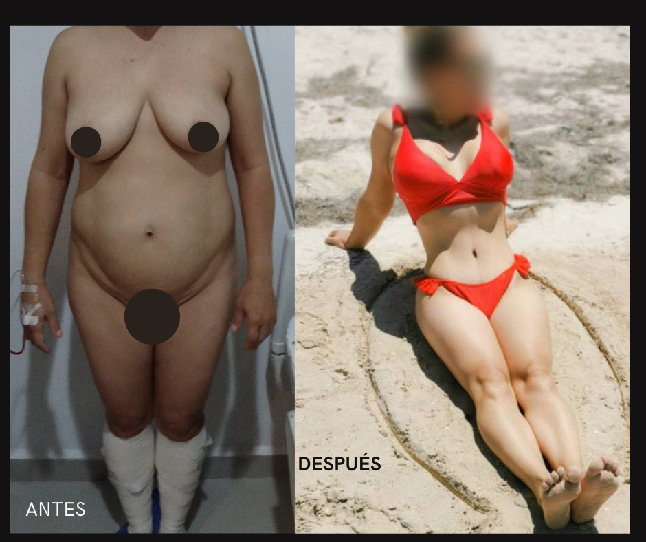 Liposucción Heus