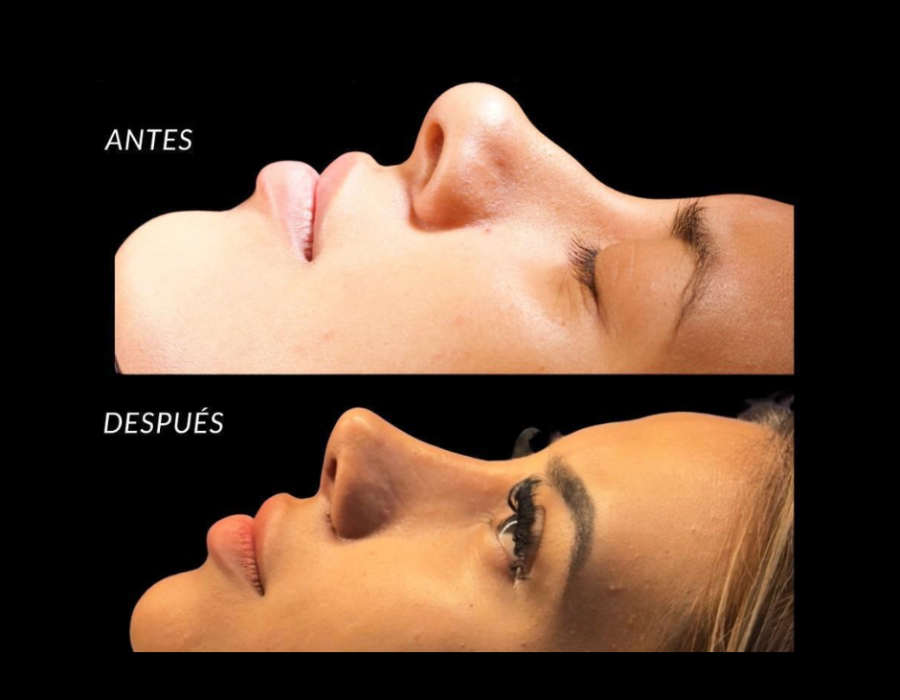Antes y después rinoplastia