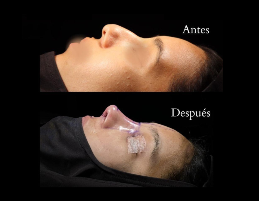 Rinoplastia natural