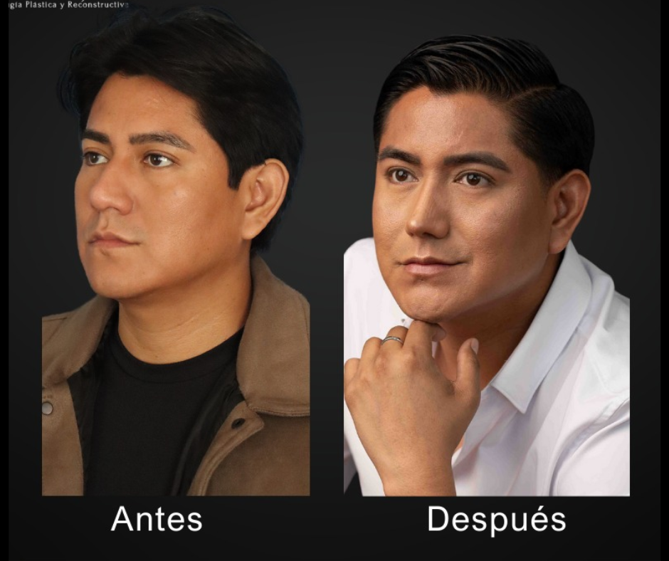 Rinoplastia en hombres Mérida, Yucatán