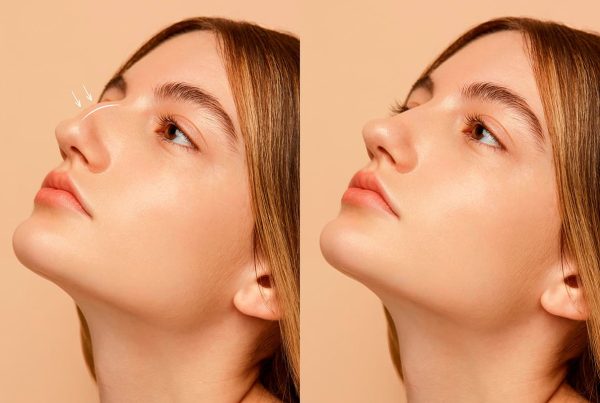 ¿Qué es la rinoplastia estructurada en aumento?