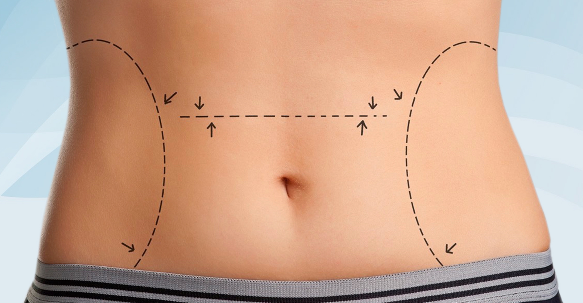 Beneficios adicionales de la abdominoplastia